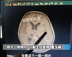 女童发烧17天脑子竟被啃出十几个洞 烟曲霉菌成元凶