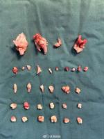 18岁女生腹中肿块里还有24颗牙齿 畸胎瘤手术成功取出