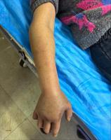 女子被蛇咬伤入院时手已肿胀 早春蛇类活跃警报