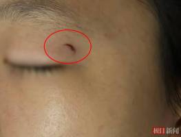 初中生遭班主任扔戒尺砸伤左眼 家长要求公开调查结果