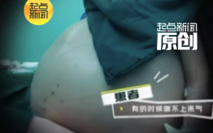 40岁女子腹腔长出104斤肿瘤 医生回应