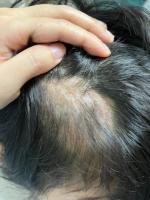 女童头上长出大脓包致永久性脱发 宠物接触成隐患