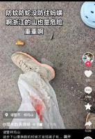 女子爬山被蚂蝗攻击伤口渗血7小时 全程无痛感引发关注