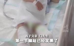 5岁男童被生母虐待：双侧小腿截断！
