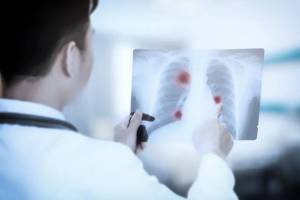 肺癌来临前，身体这五大求救信号要注意！