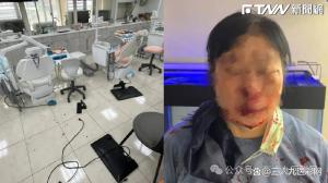 女牙醫(yī)被患者打到鼻青臉腫 洗牙疼痛引發(fā)暴力事件