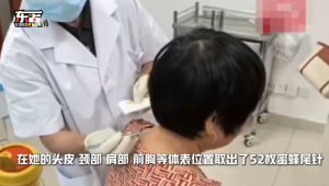 女子被蜜蜂蜇傷全身取出52枚蜂針 身上疼得麻木了,！