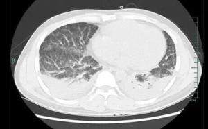 男子吃野生竹鼠后高烧 肺部感染真菌险致命