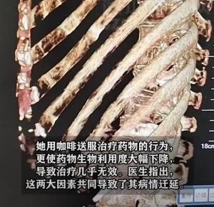 女子吃药用咖啡送服致药效减约60% 咖啡影响药物吸收