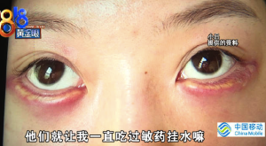 女子注射卧蚕过敏肿胀又溃烂：修复手术都做了两次，效果还是不理想