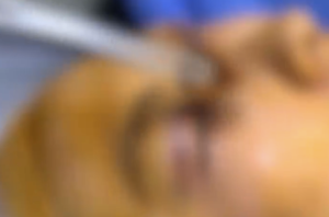 女子割双眼皮修复4次后仍像悲伤蛙 医生紧急提醒：爱美路上最忌讳盲目跟风