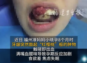女子怀孕8个月牙龈长出“红樱桃” 医生建议