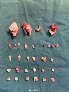 18岁女生腹中肿块里还有24颗牙齿 畸胎瘤手术成功取出