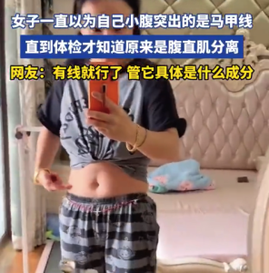 女子的“马甲线”原来是腹直肌分离