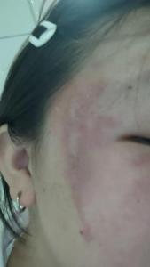 医院半天接诊12例隐翅虫皮炎患者 全因“拍了一下”惹祸