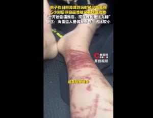 男子被沙蜇蜇伤5小时后呼吸困难 海边度假险送命