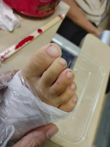 女童被蛇咬伤 家人将蛇捕获送孩子就医 紧急注射10支血清脱险