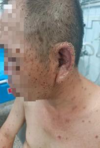 男子遭蜂群围攻 全身残留近千根毒刺 医生紧急施救化险为夷