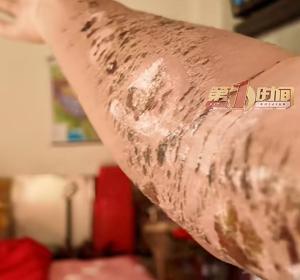小伙回家过节第一天被蛇咬伤 假期全耗医院里