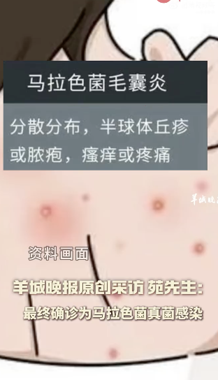 男子跑步后未擦汗感染馬拉色菌