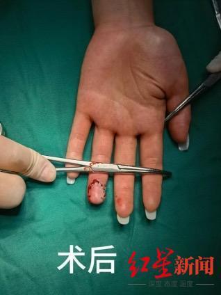 女子因美甲導(dǎo)致手指感知失靈被夾斷 厚實(shí)美甲成“元兇”