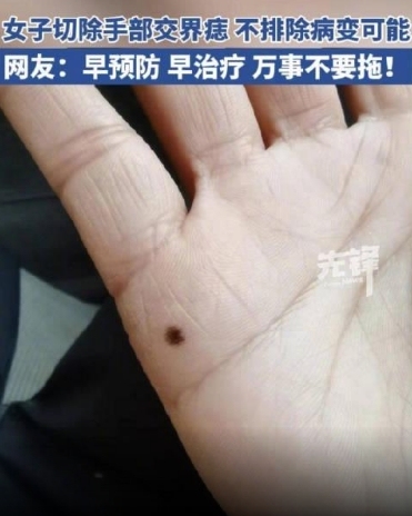 女子手部长痣三年变大确诊交界痣不排除病变可能