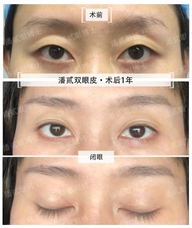 双眼皮全切和埋线有什么区别？医美小白必看的一本最全整形攻略书，广州潘贰博士科普书
