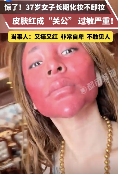 37歲女子長期不卸妝皮膚出問題 22年未卸妝引發(fā)嚴(yán)重過敏