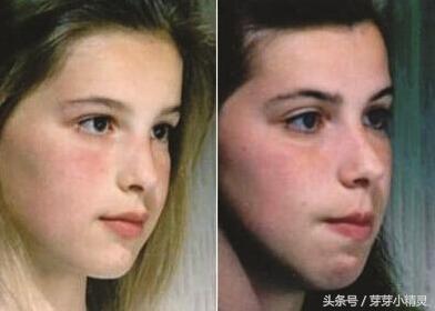 口呼吸会让人变丑是真的吗 经口呼吸面容图片大全