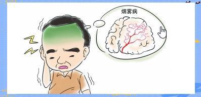 女子年年脑梗一查是罕见烟雾病 罕见病因需警惕