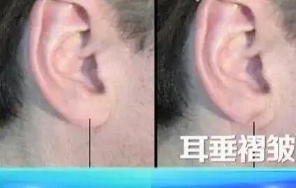 血管堵不堵 看臉和腿就知道？6個信號別忽視