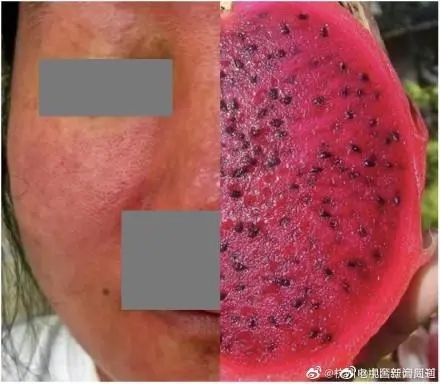 杭州女子养仓鼠脸烂成火龙果 一查得了恙虫病