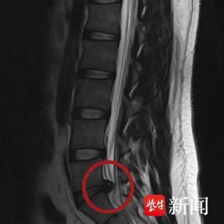 体重200斤大学生久坐致腰椎做手术 久坐打游戏惹的祸