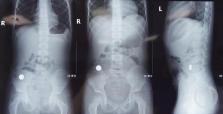 男孩吞服2枚磁鐵致4處腸穿孔 緊急手術(shù)挽救生命