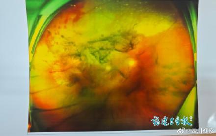 男子被足球砸中右眼视力仅剩0.01 眼球内伤恢复至0.6