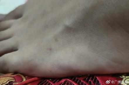男子没察觉遭毒蛇咬 一通电话救命 及时送医转危为安
