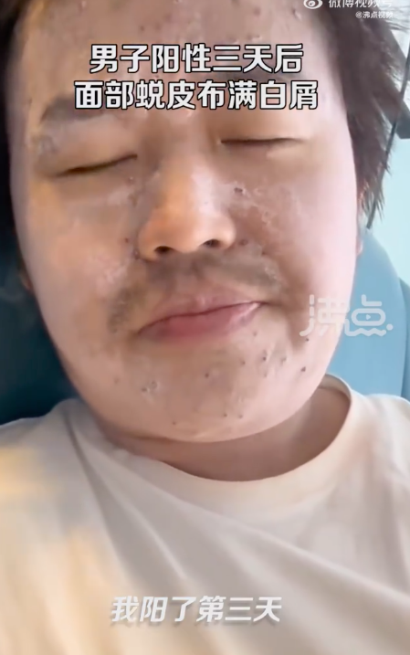 男子阳性3天后面部蜕皮布满白屑