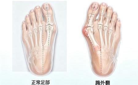 第一批穿德训鞋的受害者出现了 碳板鞋引发脚疼问题