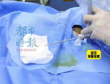 1岁半幼儿尿道藏10余颗结石 医生：要保证充足饮水均衡饮食