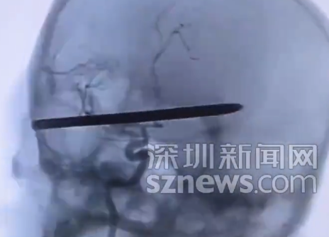 除草机弹起18cm钢钻刺穿男子头颅:医生手术4小时取出