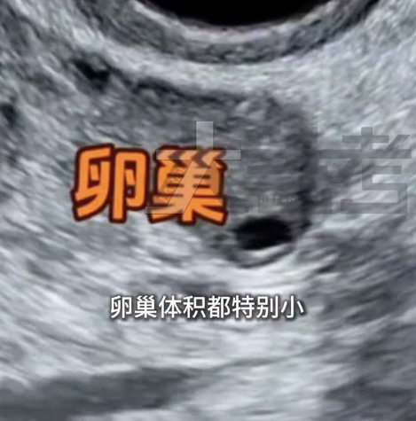 26岁女子每天熬夜致卵巢早衰绝经 医生建议女性10点半前睡觉-“食脑虫”感染是一