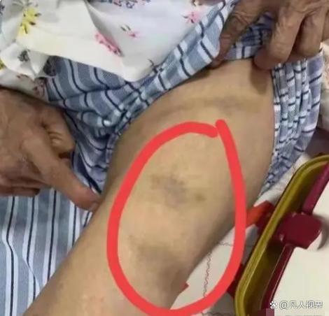 成都一养老院老人疑被打 呼唤社会的关注与行动