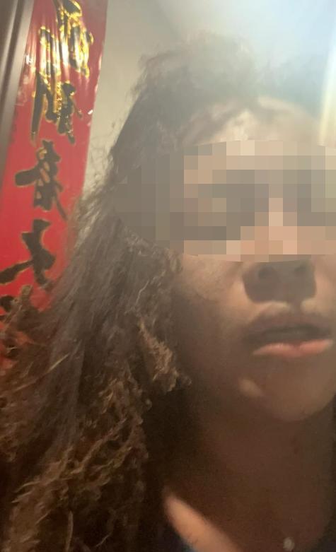被炸伤女主播：被嫌疑人骚扰两年 面部颈部严重烧伤