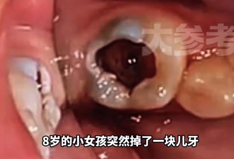 女孩每晚刷牙后吃甜食六龄齿损伤:六龄齿不会换新牙失去了就是一辈子