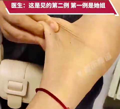 大開眼界！女子患怪病皮膚松到嚇人可隨意拉扯