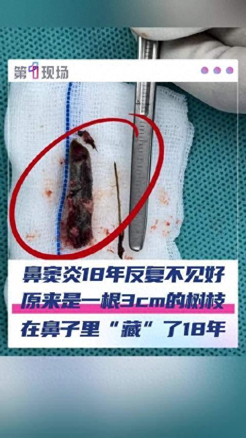 男子鼻腔插入树枝近20年