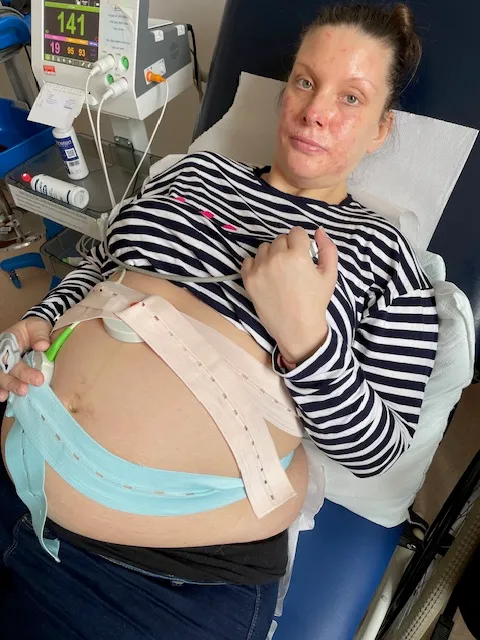 英国女子流产手术没做好，部分胎儿组织留在她体内，致其中毒濒死