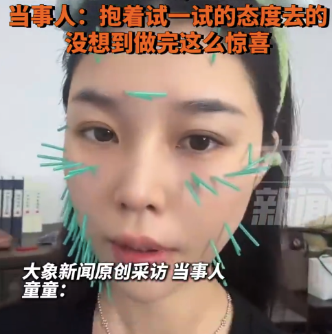 女子中医针灸改善面部下垂效果显著：本来就是抱着试一试的态度去的