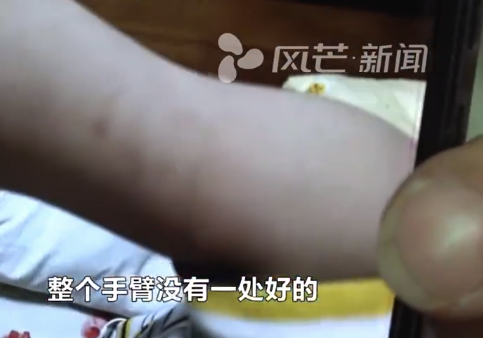 自闭症患儿受伤家长质疑老师暴力训练 机构承认用力过猛