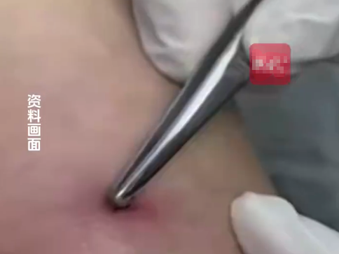 女子长出一颗“痣”发现是蜱虫 医生提醒蜱虫叮咬不要强行用手捏拽